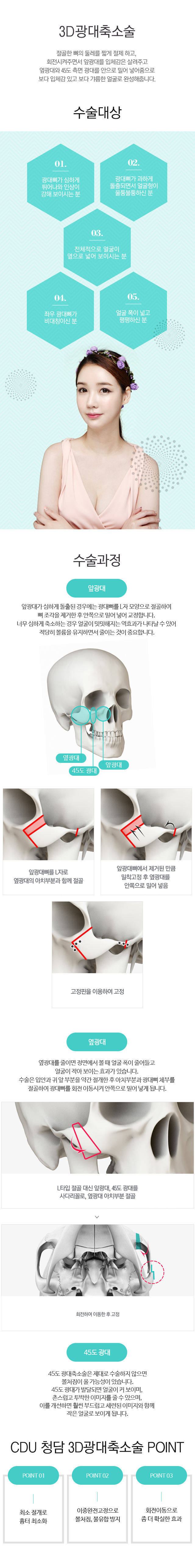 3d광대축소술